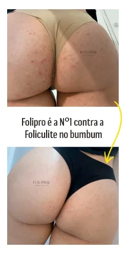 Antes e depois do cuidado com foliculite no bumbum