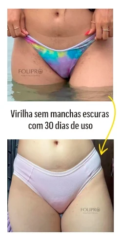 Antes e depois do cuidado com manchas na virilha