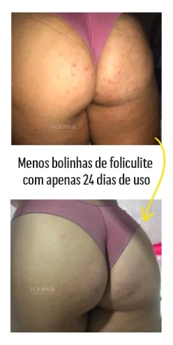 Antes e depois do cuidado com bolinhas de foliculite